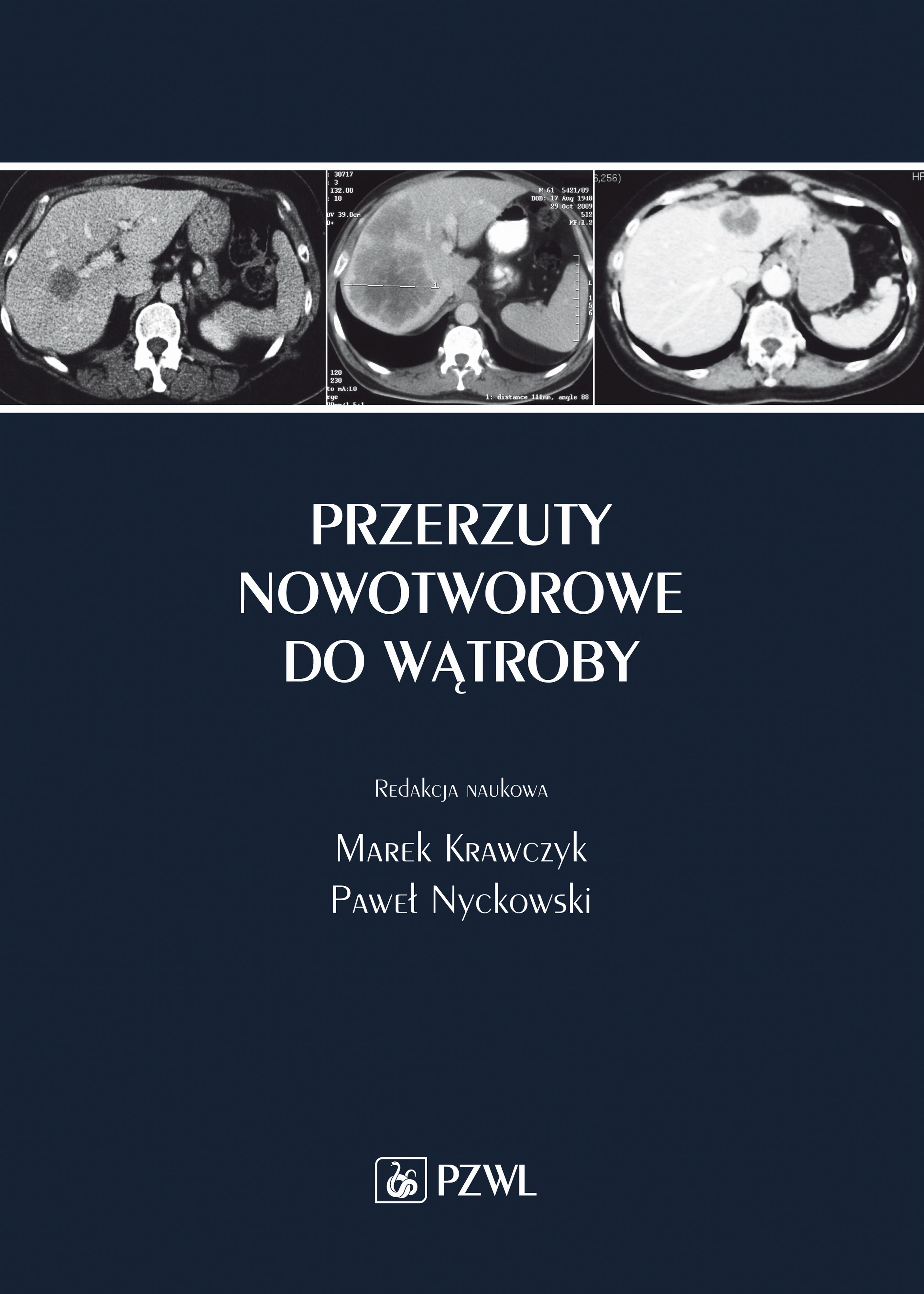 Przerzuty nowotworowe do wątroby, zdjęcie produktu, kategoria Pokonaj raka