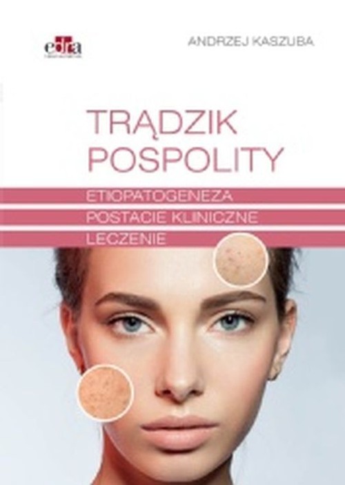 Trądzik pospolity, zdjęcie produktu, kategoria Choroby skóry